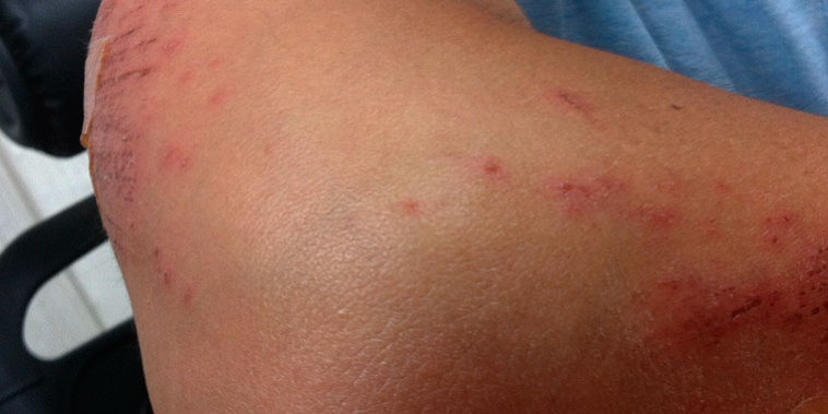 Cómo afectan las plagas a nuestra salud Los peligros de las plagas a nuestra salud