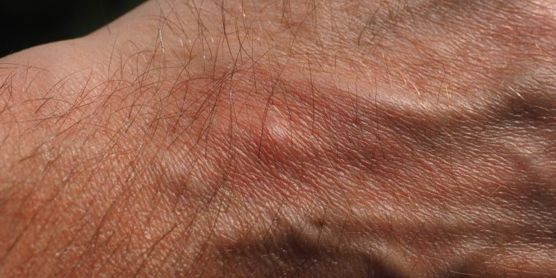 ¿Debo ir al médico tras la picadura de un insecto? Cuándo ir al médico tras picaduras de insectos