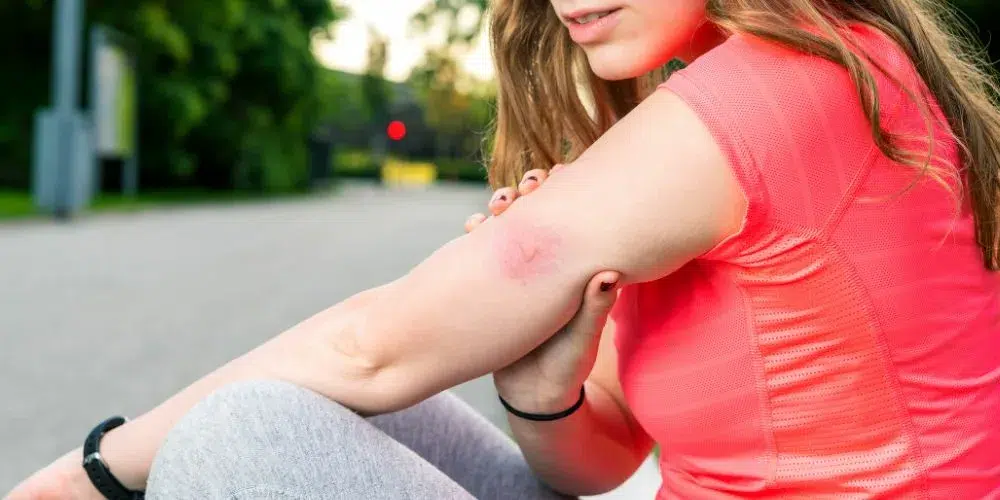 ¿Qué tipo de mosquito me ha picado – A tu Salud ¿Qué tipo de mosquito me ha picado - A tu Salud